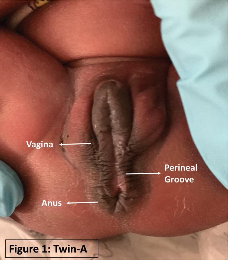 Congenital Perineal Groove Defect in Monozygotic Twin Infants: A Literature Review.