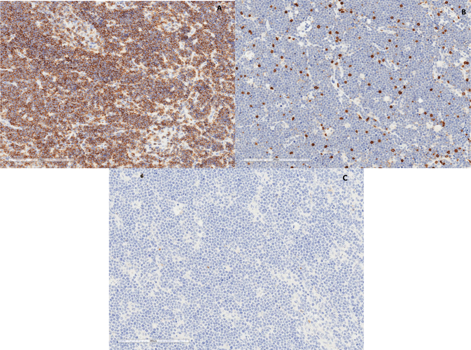 High Expression of TIM 3 and Galectin 9 on Immunohistochemistry Staining of Tumor Specimen at Diagnosis in Pediatric Patients with Ewing Sarcoma.