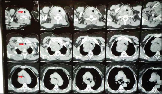 Challenging Airway Management in a Patient with Retrosternal Goiter Presenting in Respiratory Distress.