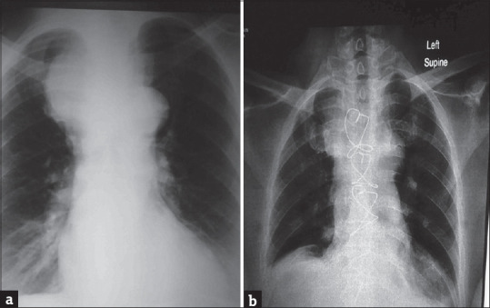 Challenging Airway Management in a Patient with Retrosternal Goiter Presenting in Respiratory Distress.