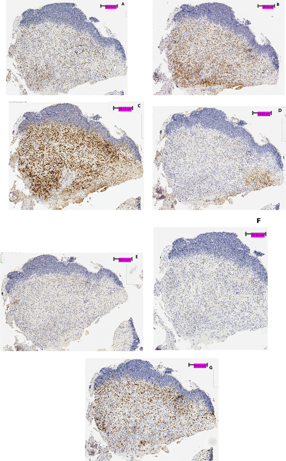 High Expression of TIM 3 and Galectin 9 on Immunohistochemistry Staining of Tumor Specimen at Diagnosis in Pediatric Patients with Ewing Sarcoma.