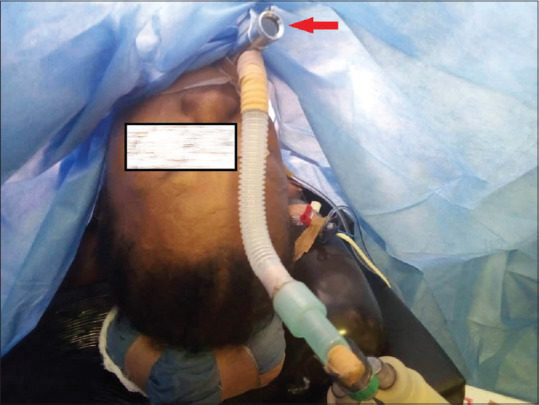 Challenging Airway Management in a Patient with Retrosternal Goiter Presenting in Respiratory Distress.