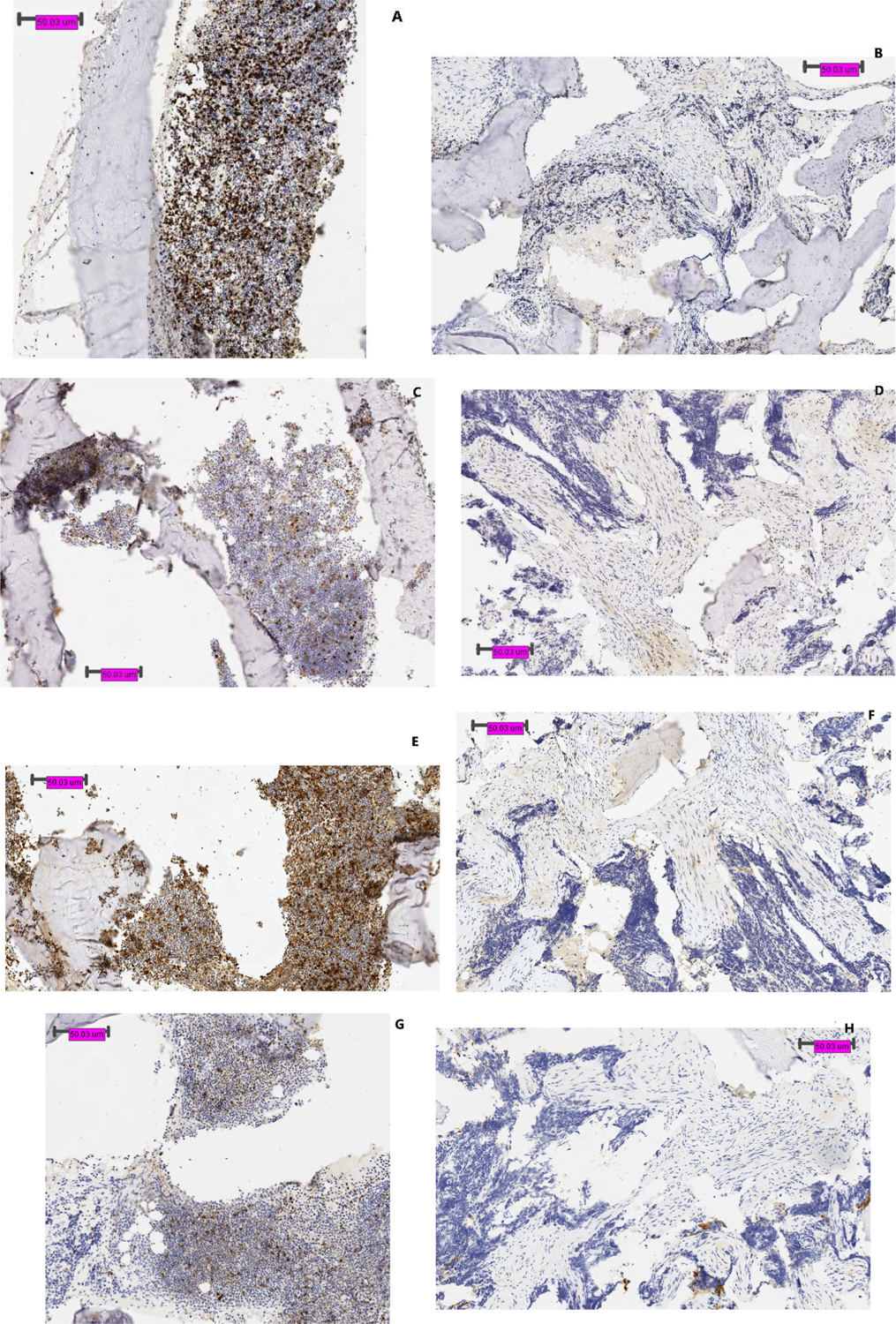 High Expression of TIM 3 and Galectin 9 on Immunohistochemistry Staining of Tumor Specimen at Diagnosis in Pediatric Patients with Ewing Sarcoma.