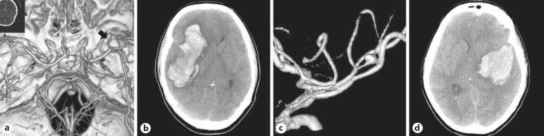 Warning Signs in the Era of Unruptured Intracranial Aneurysms: Report on 2 Cases of Fatal Aneurysmal Hemorrhage.