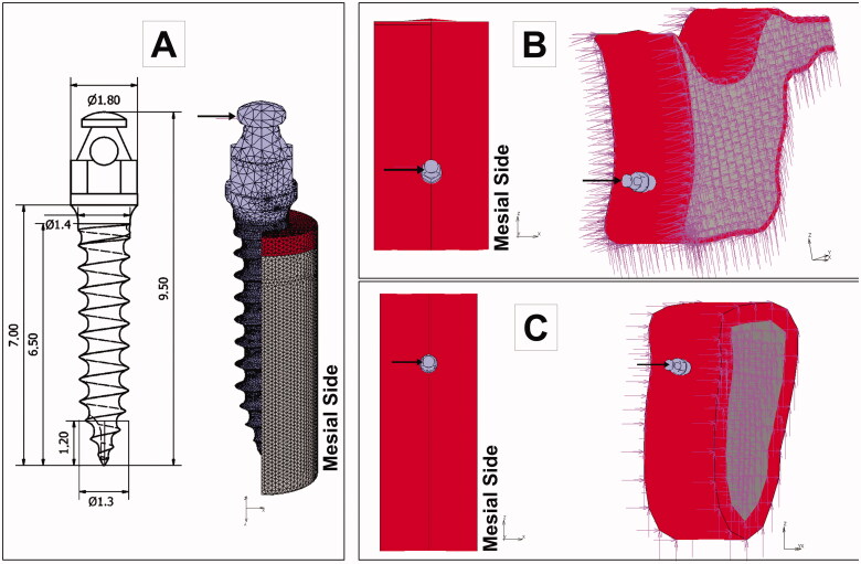 Can maxilla and mandible bone quality explain differences in orthodontic mini-implant failures?