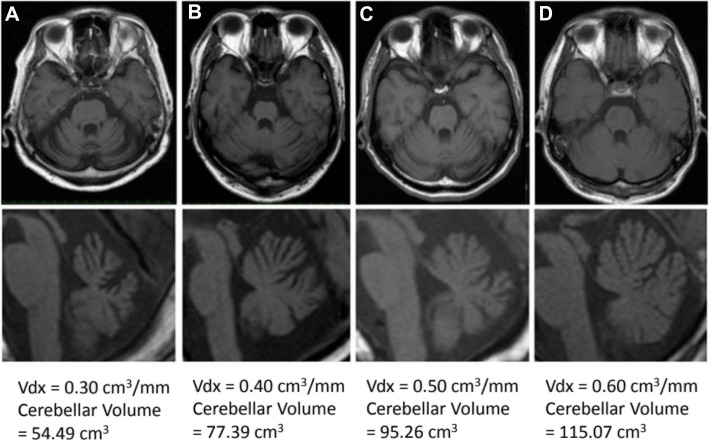 The critical need to develop tools assessing cerebellar reserve for the delivery and assessment of non-invasive cerebellar stimulation.