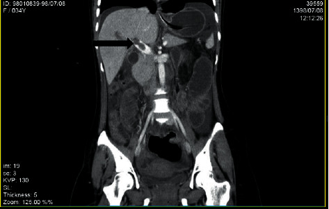 Portal Vein Thrombosis following Total Colectomy due to Colonic Inertia: A Case Report and Evaluation of Risk Factors.