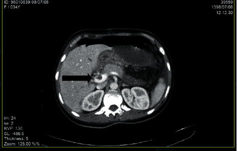 Portal Vein Thrombosis following Total Colectomy due to Colonic Inertia: A Case Report and Evaluation of Risk Factors.