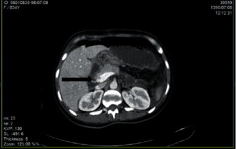 Portal Vein Thrombosis following Total Colectomy due to Colonic Inertia: A Case Report and Evaluation of Risk Factors.