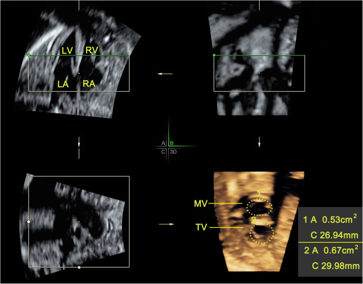 Prenatal evaluation of fetal atrioventricular valves by real-time 4D volume imaging with electronic matrix probe.