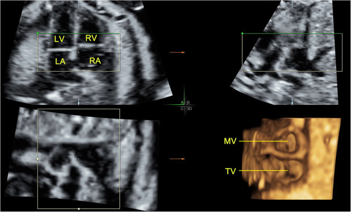 Prenatal evaluation of fetal atrioventricular valves by real-time 4D volume imaging with electronic matrix probe.