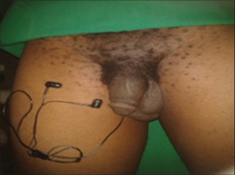 A Self-Insertion of an Uncommon Urethrovesical Foreign Body for Autoerotism.