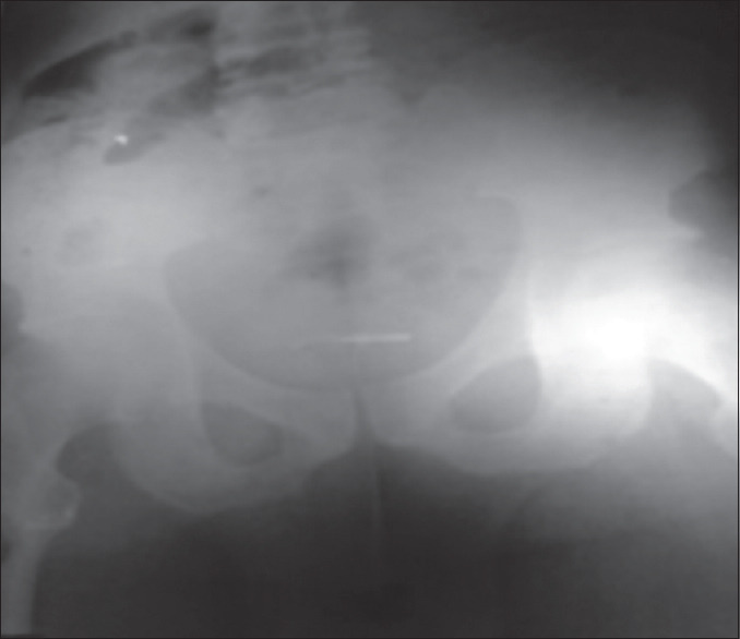 A Self-Insertion of an Uncommon Urethrovesical Foreign Body for Autoerotism.