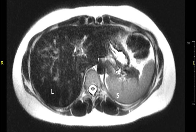 Juvenile Hemochromatosis: Rheumatic Manifestations of 2 Sisters Responding to Deferasirox Treatment. A Case Series and Literature Review.