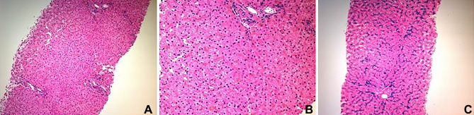 Juvenile Hemochromatosis: Rheumatic Manifestations of 2 Sisters Responding to Deferasirox Treatment. A Case Series and Literature Review.