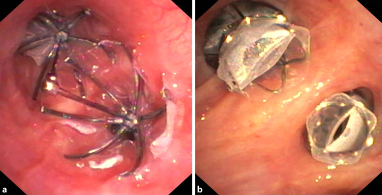 [Interventional bronchoscopy-an overview].