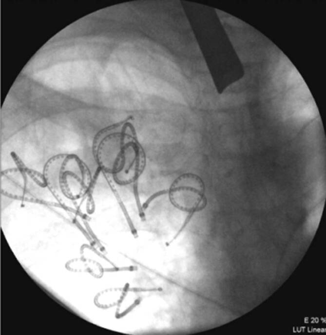 [Interventional bronchoscopy-an overview].