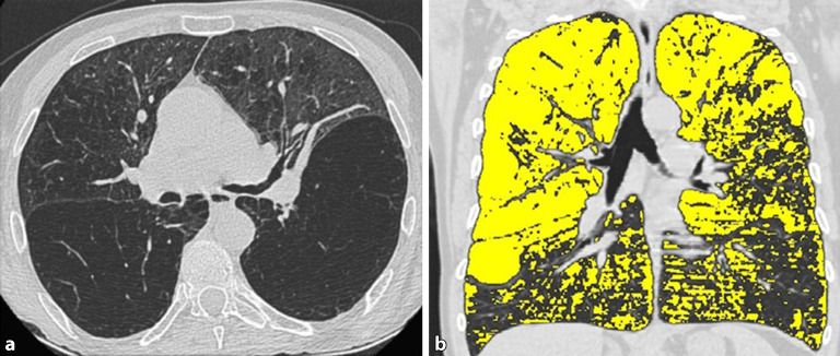 [Interventional bronchoscopy-an overview].