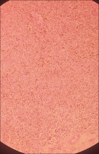 Anal Melanoma: A Case Report of a Rare and Lethal Malignancy in a Suburban Nigerian Teaching Hospital.