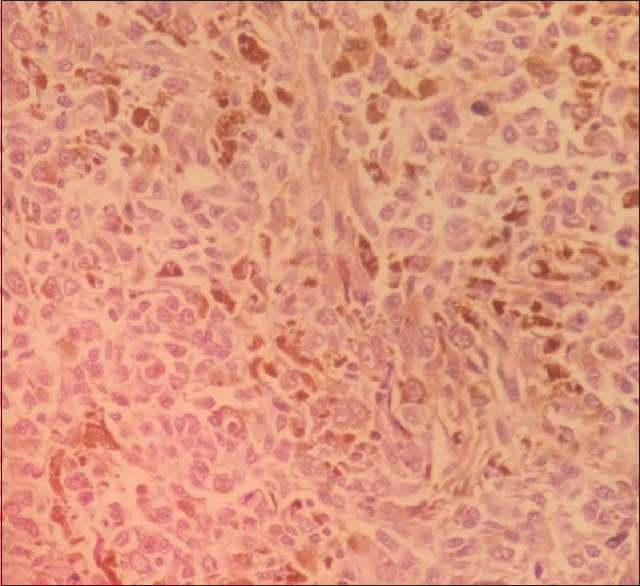 Anal Melanoma: A Case Report of a Rare and Lethal Malignancy in a Suburban Nigerian Teaching Hospital.