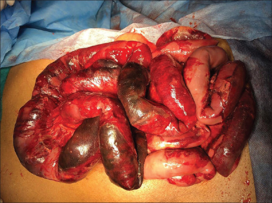 Outcomes of Management of Patients with Acute Mesenteric Ischemia: A Prospective Study.