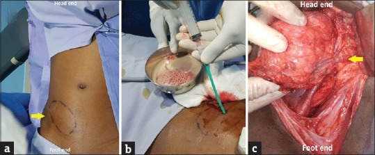Ectopic Kidney Mimicking Appendicular Abscess.