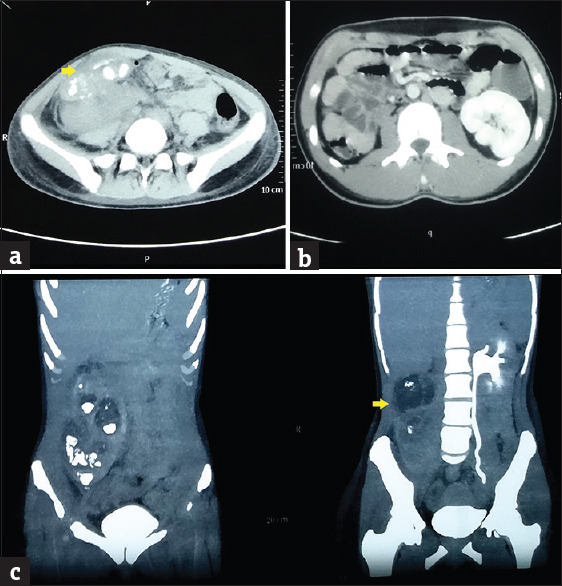 Ectopic Kidney Mimicking Appendicular Abscess.