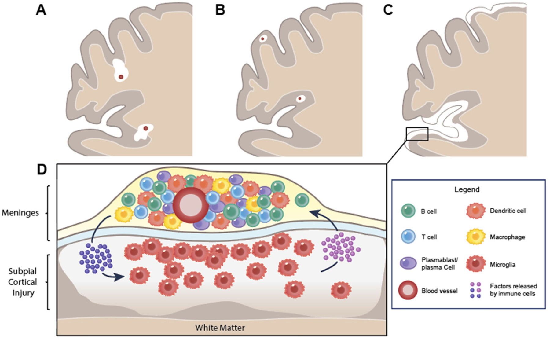 Inflammatory mechanisms underlying cortical injury in progressive multiple sclerosis.