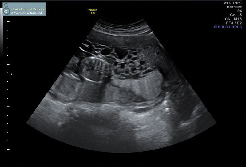 Complete Molar Pregnancies with a Coexisting Fetus: Pregnancy Outcomes and Review of Literature.