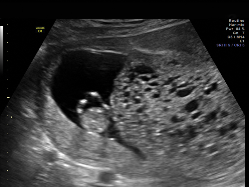 Complete Molar Pregnancies with a Coexisting Fetus: Pregnancy Outcomes and Review of Literature.