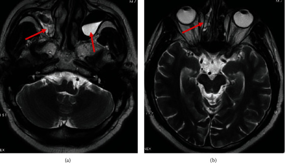 Sinoorbital Mucormycosis Associated with Corticosteroid Therapy in COVID-19 Infection.