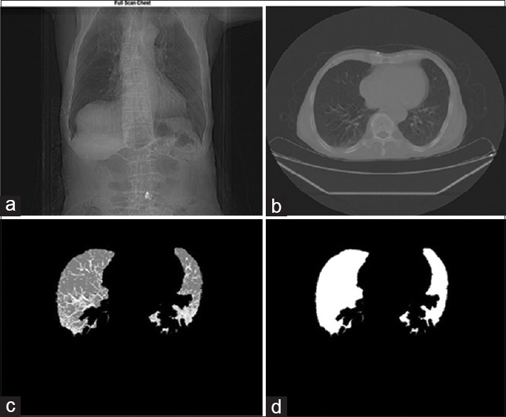 Detection and Classification of COVID-19 by Lungs Computed Tomography Scan Image Processing using Intelligence Algorithm.
