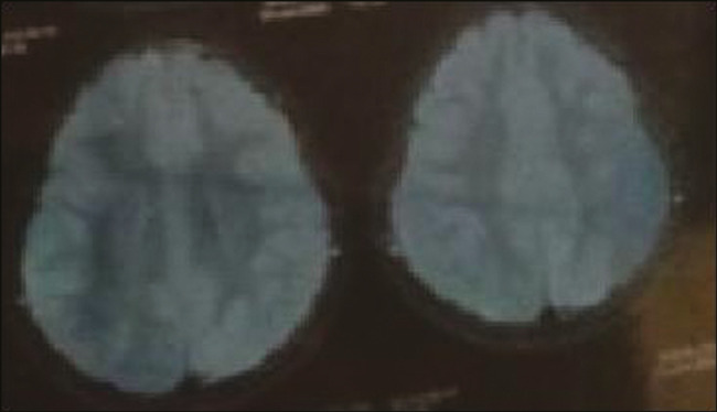 Clinical Phenotype of FASTKD2 Mutation.