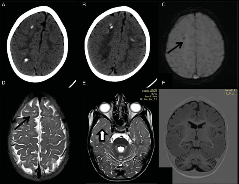 Treatable Neurodegenerative Disorder: Cerebral Folate Transport Deficiency--Two Children from Southern India.