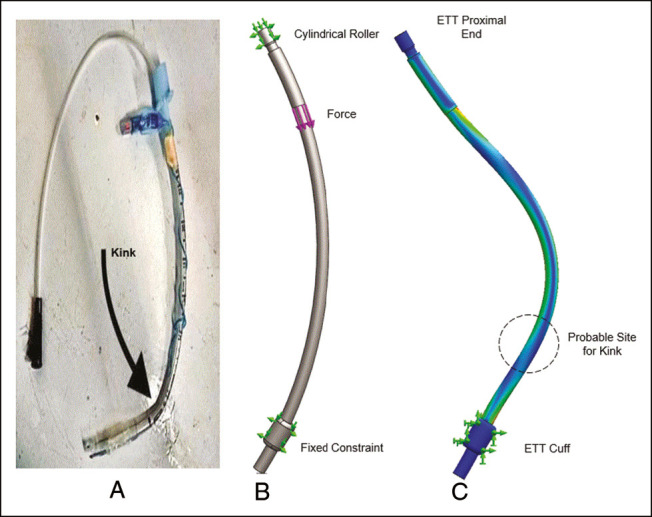 Tracheal Tube Kinking Amidst Prone Position During Neurosurgical Procedures: An Attempt to Elucidate the Mechanism.