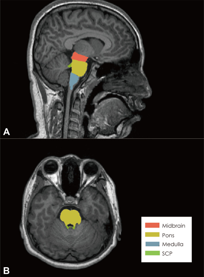 Reduced Volume of a Brainstem Substructure in Adolescents with Problematic Smartphone Use.