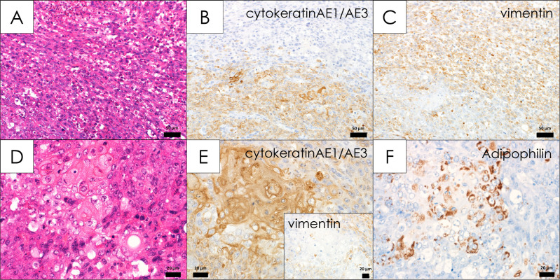 A case of spontaneous Zymbal's gland carcinoma with lung metastasis in an aged Fischer 344 rat.