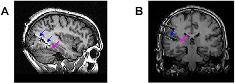 Comparing stimulus-evoked and spontaneous response of the face-selective multi-units in the human posterior fusiform gyrus.