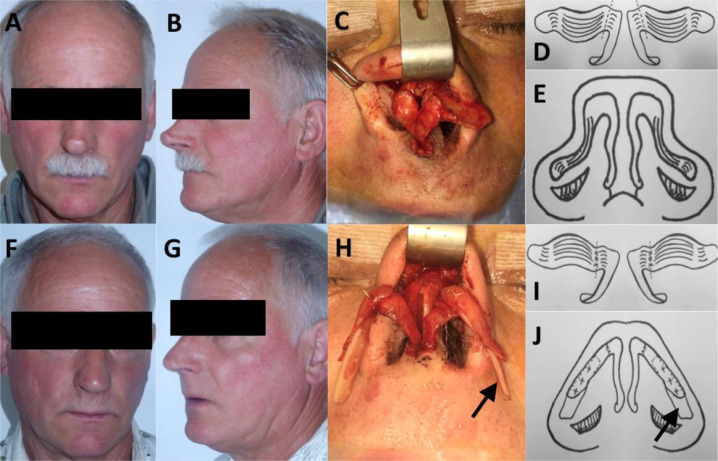 Lower lateral crural turnover flap combined with alar batten graft for the long-term result of the treatment of alar convexities.