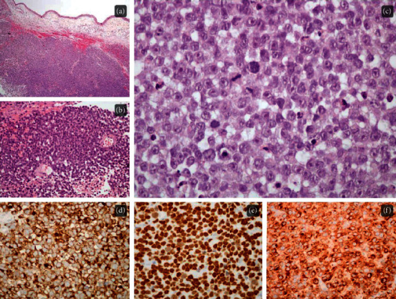 Immunotherapy in Metastatic Mucosal Melanoma with Disseminated Intravascular Coagulation: A Case of Success.