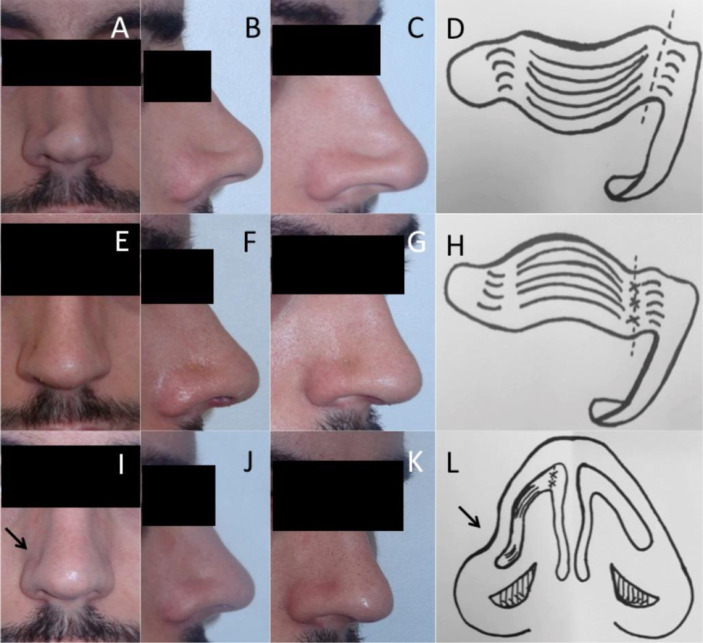 Lower lateral crural turnover flap combined with alar batten graft for the long-term result of the treatment of alar convexities.