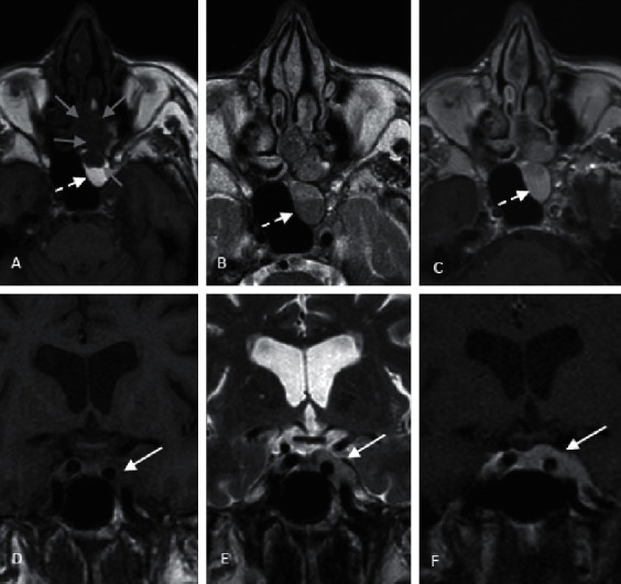 Immunotherapy in Metastatic Mucosal Melanoma with Disseminated Intravascular Coagulation: A Case of Success.