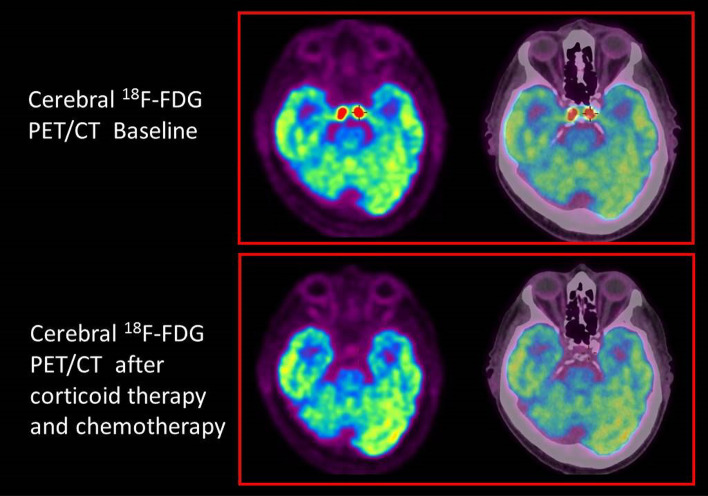 Painful ophthalmoplegia in a patient with a history of marginal zone lymphoma.