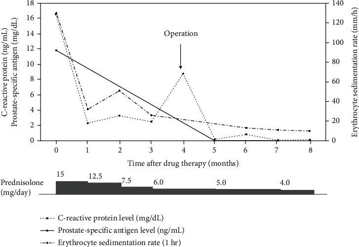 A Case of Localized Prostate Cancer Associated with Polymyalgia Rheumatica with Marked Symptomatic Improvement after Robot-Assisted Radical Prostatectomy.