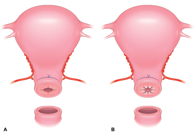 Abdominal Radical Trachelectomy.