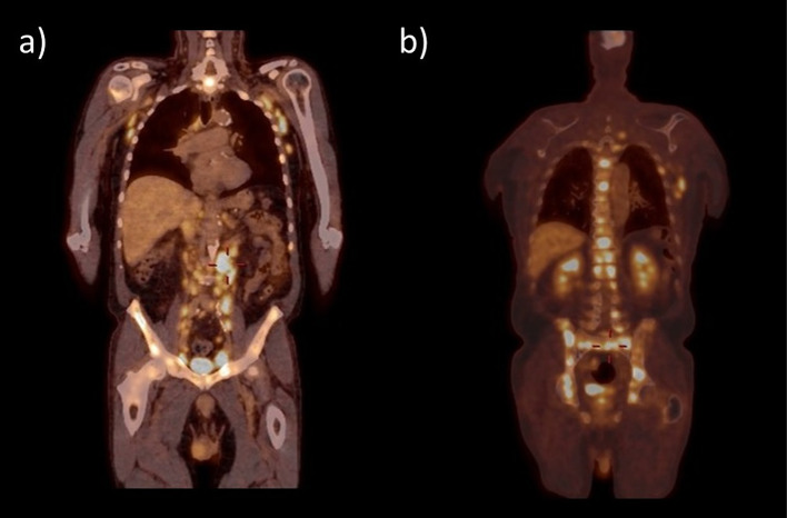 Painful ophthalmoplegia in a patient with a history of marginal zone lymphoma.