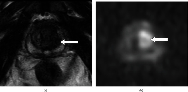 A Case of Localized Prostate Cancer Associated with Polymyalgia Rheumatica with Marked Symptomatic Improvement after Robot-Assisted Radical Prostatectomy.