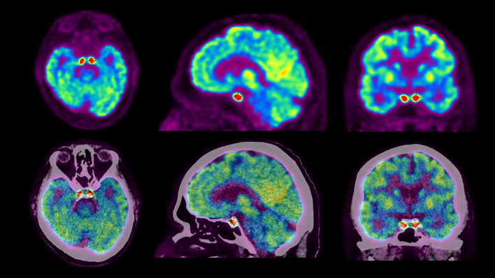 Painful ophthalmoplegia in a patient with a history of marginal zone lymphoma.