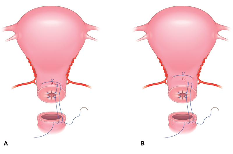 Abdominal Radical Trachelectomy.