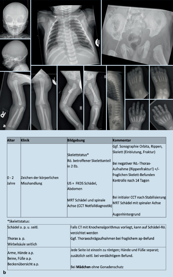 [Guideline adherence and quality assurance in radiological diagnostics in cases of suspected child abuse in Germany].